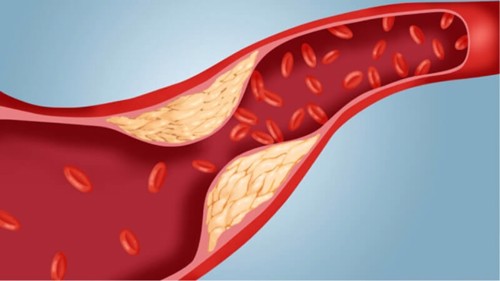 Ai bị tăng huyết áp và mỡ máu cao – Dùng ngay sản phẩm từ thảo dược Định Áp Vương